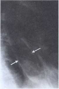 Рис. 2.2. Рентгенологическое исследование пищевода. Картина