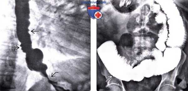 Рентгенограмма (эзофагография) при склеродермии пищевода