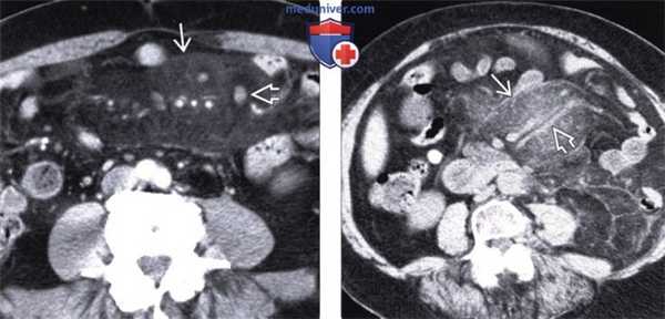 КТ, МРТ при склерозирующем мезентерите