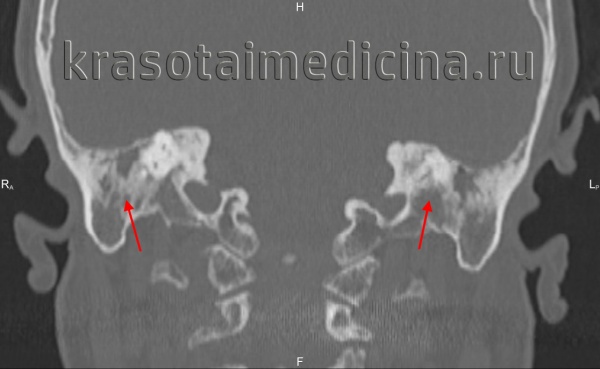 КТ височных костей. С обеих сторон диффузное снижение пневматизации ячеек сосцевидного отростка и пирамиды височной кости за счет отосклероза