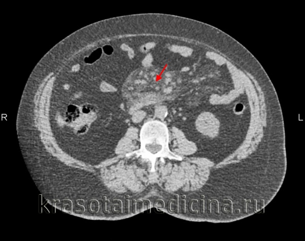 КТ органов брюшной полости. Увеличение размеров и количества лимфоузлов в корне брыжейки тонкой кишки на фоне выраженного ее уплотнения