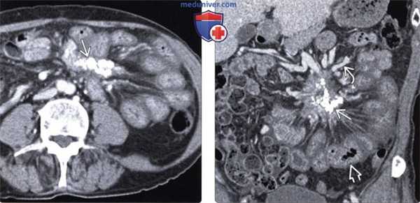 КТ, МРТ при склерозирующем мезентерите