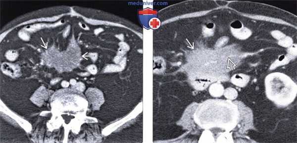 КТ, МРТ при склерозирующем мезентерите