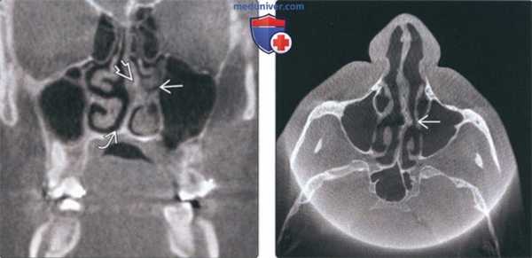 Лучевая диагностика смещенной носовой перегородки