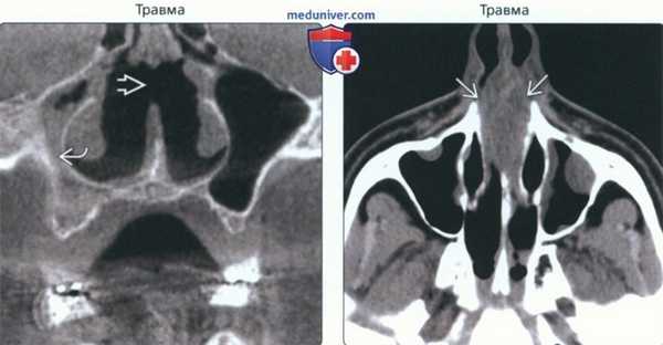 КТ, МРТ при перфорации носовой перегородки