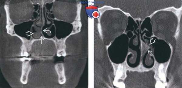 Лучевая диагностика смещенной носовой перегородки