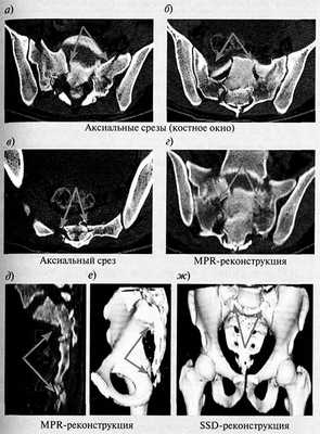 стресс-перелом крестца и копчика