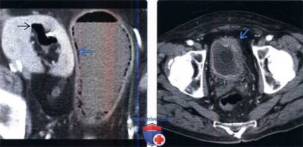 КТ при цистите