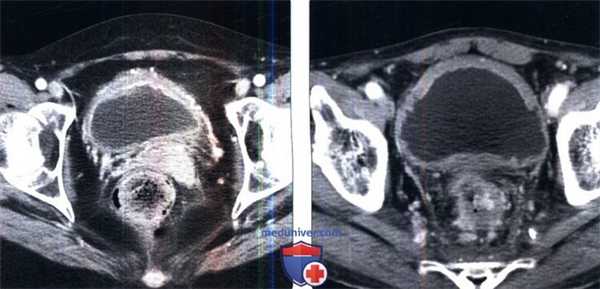 КТ при цистите