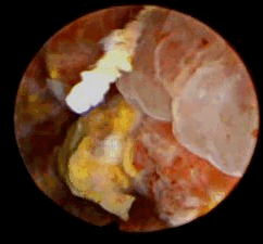 Цистоскопическое обследование пациента М. Цистоскопическая картина солидного образования, вдающегося в полость мочевого пузыря в виде массивных бугристых масс, покрытых отечной слизистой оболочкой с очагами кровоизлияний, с явлениями распада и инкрустации солями