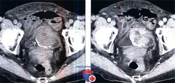 КТ при воспалительной псевдоопухоли мочевого пузыря