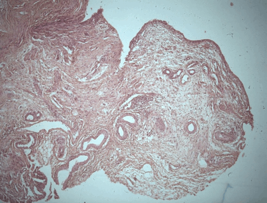 Патоморфологическое исследование пациента С. Морфологическая картина полипоидного цистита. Окраска гематоксилин-эозином, х5