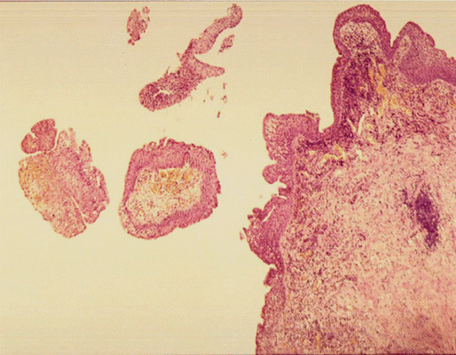 Патоморфологическое исследование пациентки К. Морфологическая картина полипоидного цистита. Окраска гематоксилин-эозином, х5