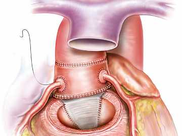 Фото Стеноз