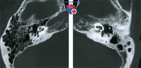 Хронический отомастоидит с эрозиями слуховых косточек - лучевая диагностика