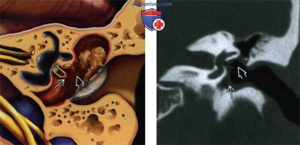 Хронический отомастоидит с эрозиями слуховых косточек - лучевая диагностика