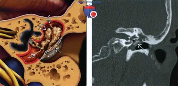 Хронический отомастоидит с тимпаносклерозом - лучевая диагностика