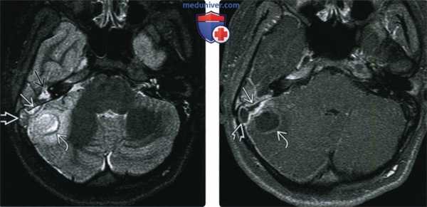 КТ, МРТ при коалесцентном отомастоидите и его осложнениях