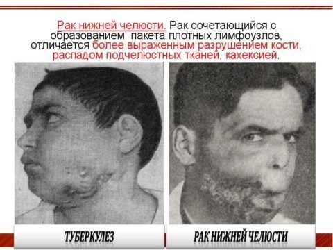 Рак нижней челюсти