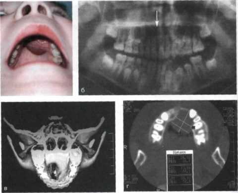 Рак верхней челюсти симптомы