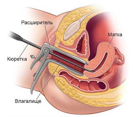 Выскабливание полости матки