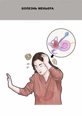 Болезнь Меньера