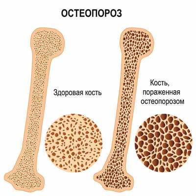 Тендовагинит стопы