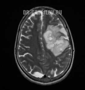 Анапластическая астроцитома