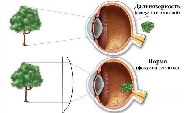 Гиперметропия (дальнозоркость) является распространенным заболеванием