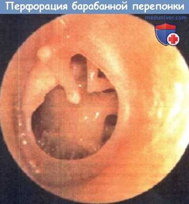 Перфорация барабанной перепонки