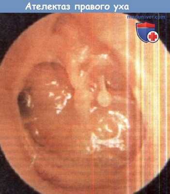 Ателектаз правого уха