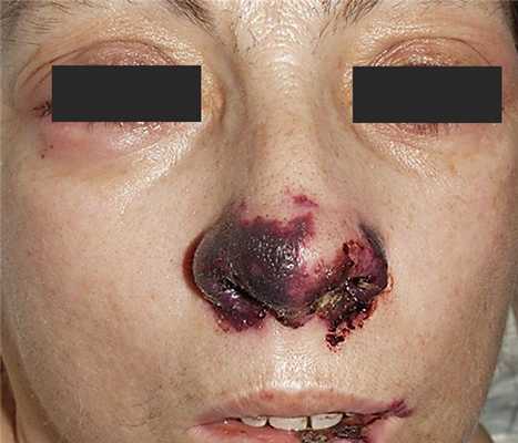 ГРАНУЛЕМАТОЗ ВЕГЕНЕРА.jpg