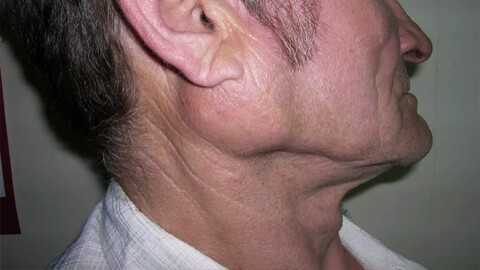 опухоли слюнных желез