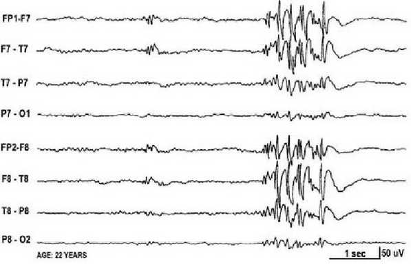 Судорожный синдром у детей