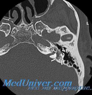 причины отосклероза