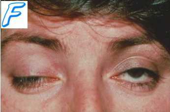 эндогенная интоксикация