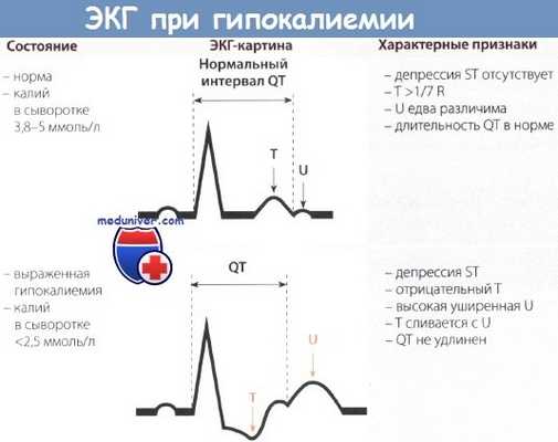 ЭКГ при гипокалиемии