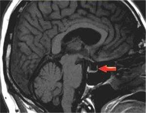 Пустое турецкое седло на МРТ