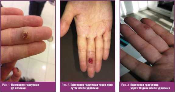 Пиогенная гранулема