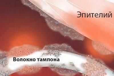 Токсический шок со стафилококковым типом