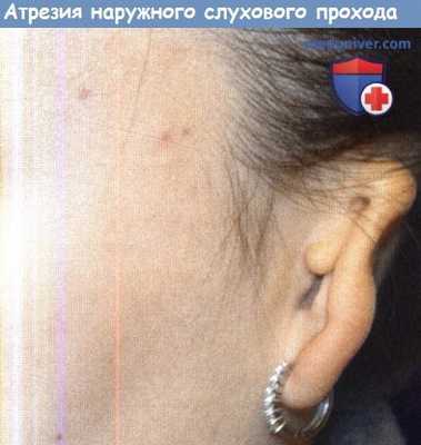 Атрезия наружного слухового прохода