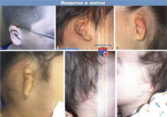 Микротия и анотия различной степени