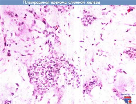 Цитология (гистология) слюнной железы при плеоформной аденоме