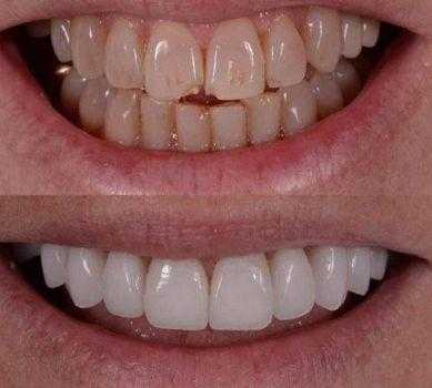 Виниры до и после