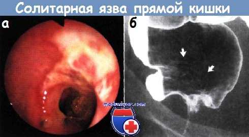 Солитарная язва прямой кишки
