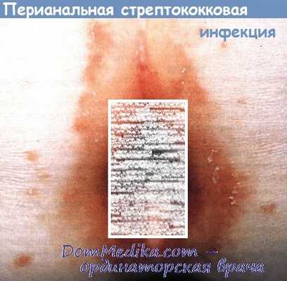 Перианальный дерматит при стрептококковой инфекции