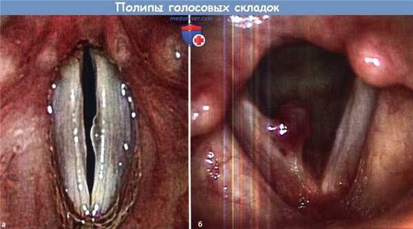 Полипы голосовых складок