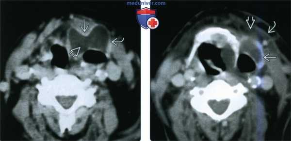 КТ, МРТ при ларингоцеле