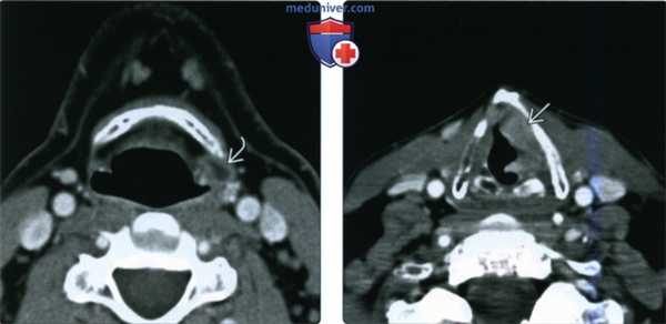 КТ, МРТ при ларингоцеле