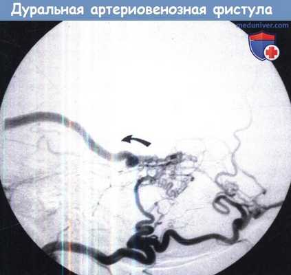Дуральная артериовенозная фистула (ДАВФ)